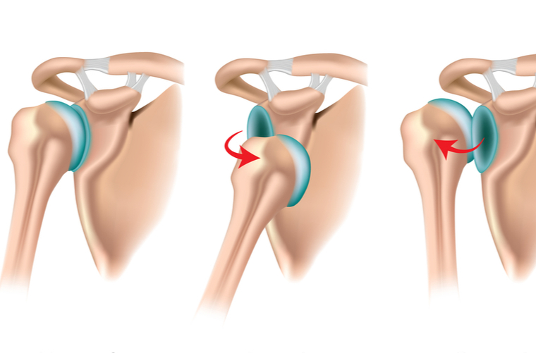LUXACIÓN HOMBRO