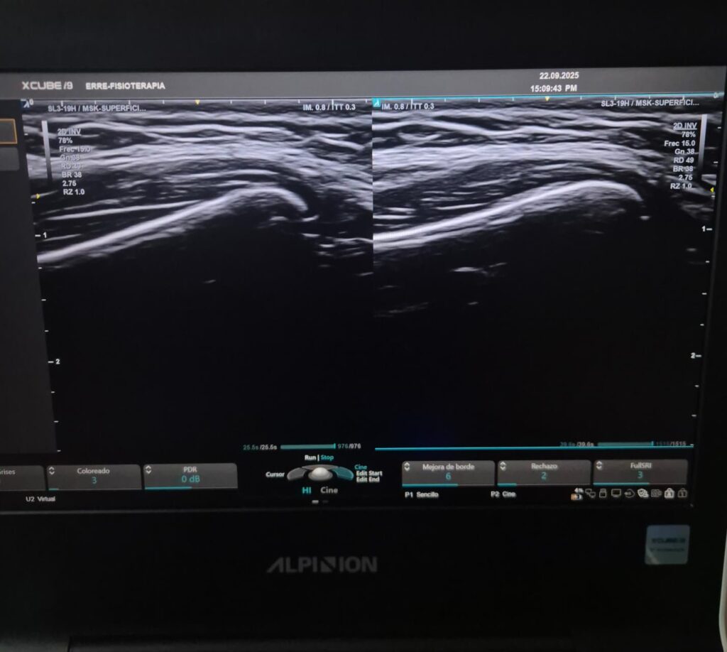 ecografia musculoesqueletica ATM